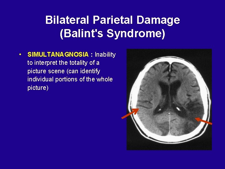 Bilateral Parietal Damage (Balint's Syndrome) • SIMULTANAGNOSIA : Inability to interpret the totality of