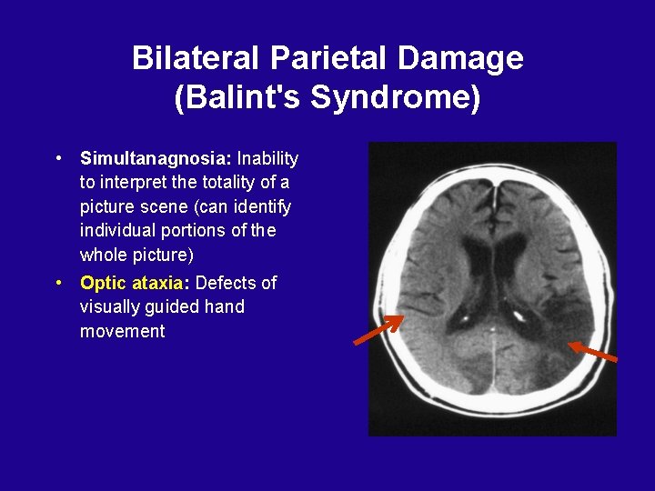 Bilateral Parietal Damage (Balint's Syndrome) • Simultanagnosia: Inability to interpret the totality of a