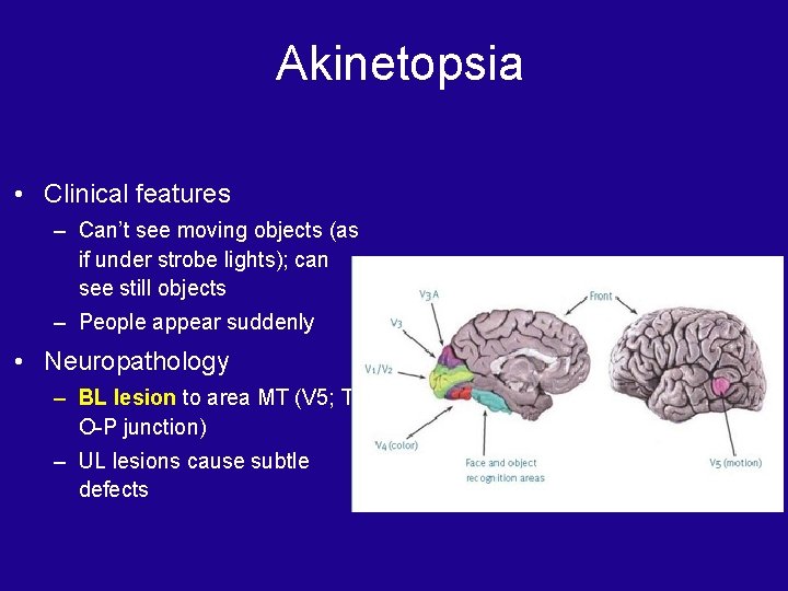 Akinetopsia • Clinical features – Can’t see moving objects (as if under strobe lights);