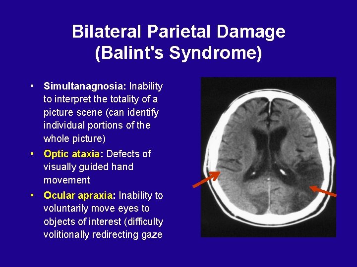 Bilateral Parietal Damage (Balint's Syndrome) • Simultanagnosia: Inability to interpret the totality of a