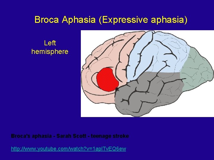 Broca Aphasia (Expressive aphasia) Left hemisphere Broca's aphasia - Sarah Scott - teenage stroke