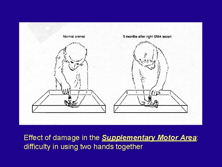 Effect of damage in the Supplementary Motor Area: difficulty in using two hands together
