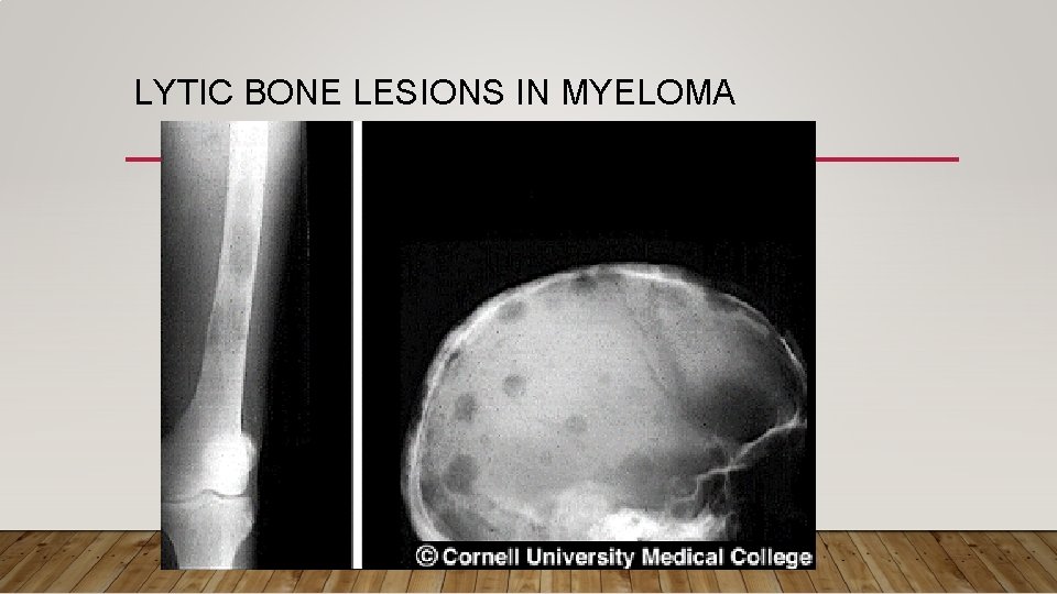 LYTIC BONE LESIONS IN MYELOMA 