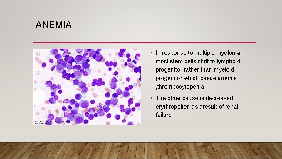 ANEMIA • In response to multiple myeloma most stem cells shift to lymphoid progenitor