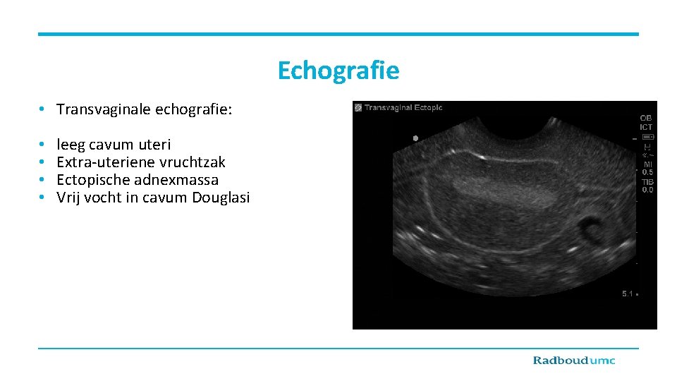 Echografie • Transvaginale echografie: • • leeg cavum uteri Extra-uteriene vruchtzak Ectopische adnexmassa Vrij