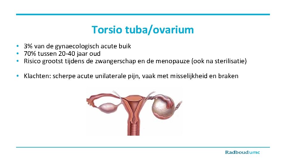Torsio tuba/ovarium • 3% van de gynaecologisch acute buik • 70% tussen 20 -40