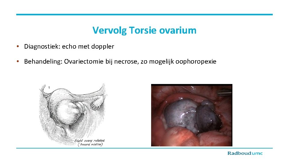 Vervolg Torsie ovarium • Diagnostiek: echo met doppler • Behandeling: Ovariectomie bij necrose, zo
