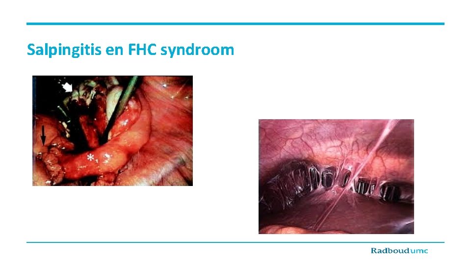 Salpingitis en FHC syndroom 