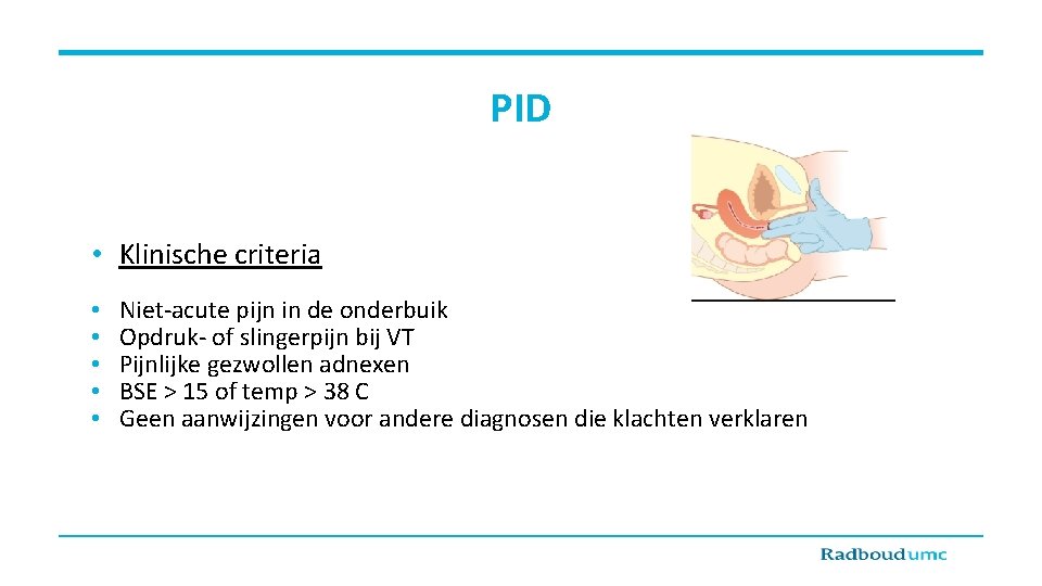 PID • Klinische criteria • • • Niet-acute pijn in de onderbuik Opdruk- of