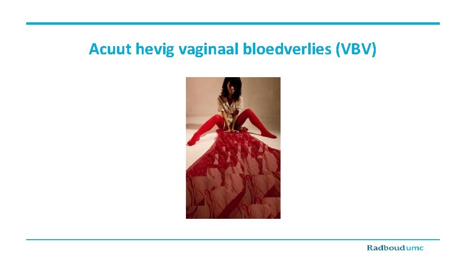 Acuut hevig vaginaal bloedverlies (VBV) 