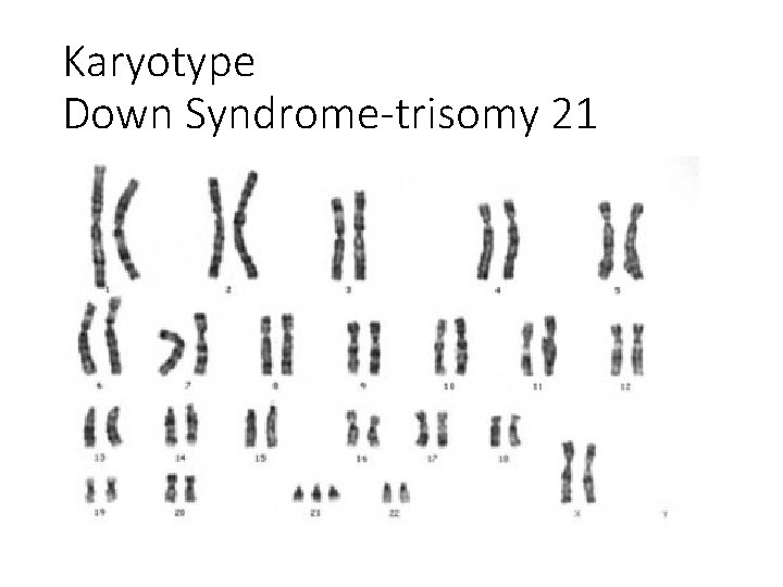 Karyotype Down Syndrome-trisomy 21 