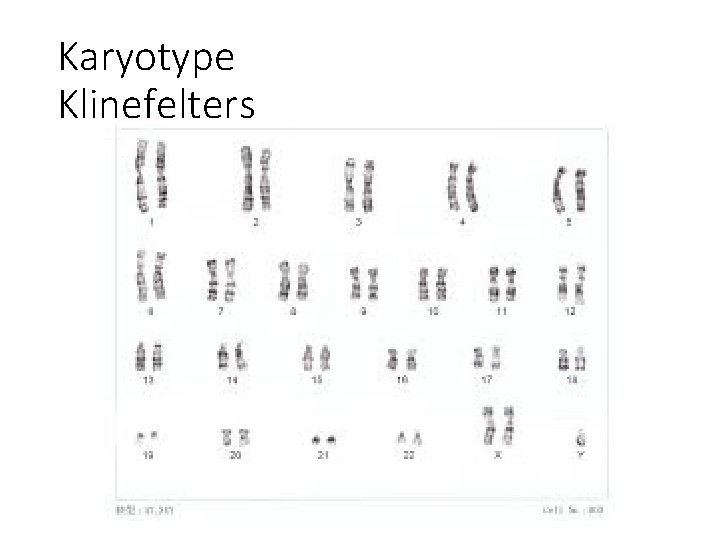 Karyotype Klinefelters 