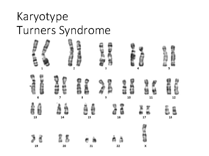Karyotype Turners Syndrome 