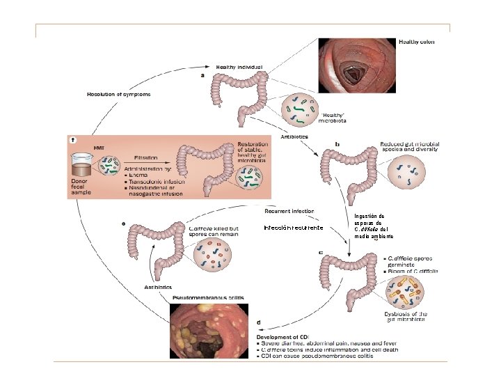 PUNTO 10. TRASPLANTE DE HECES FECALES Infección recurrente Ingestión de esporas de C. difficile