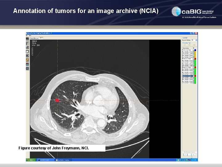 Annotation of tumors for an image archive (NCIA) Figure courtesy of John Freymann, NCI.