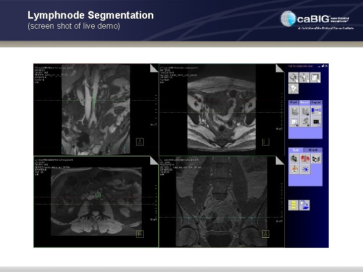 Lymphnode Segmentation (screen shot of live demo) 