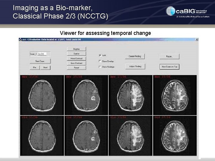 Imaging as a Bio-marker, Classical Phase 2/3 (NCCTG) Viewer for assessing temporal change 