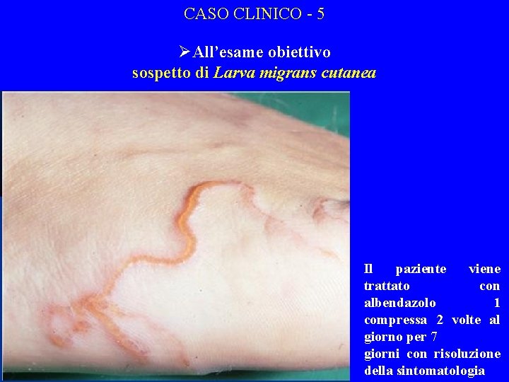CASO CLINICO - 5 ØAll’esame obiettivo sospetto di Larva migrans cutanea Il paziente viene
