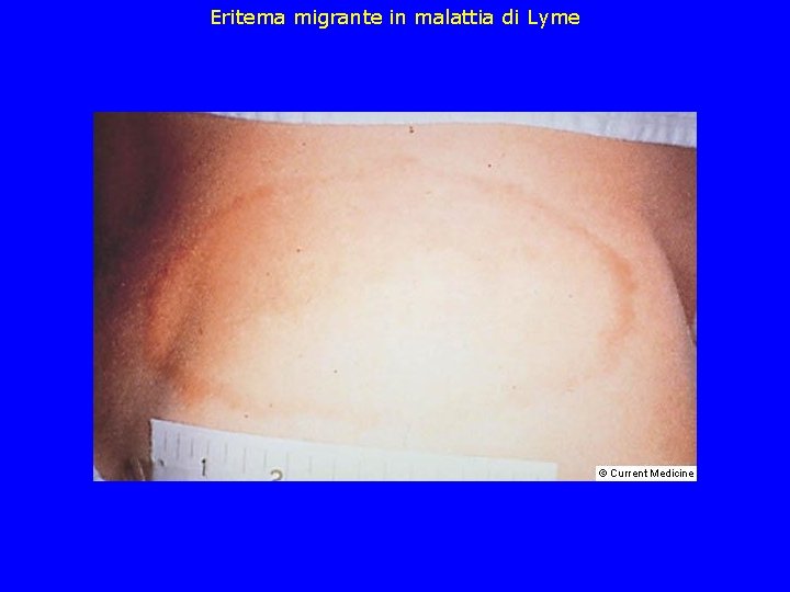 Eritema migrante in malattia di Lyme 