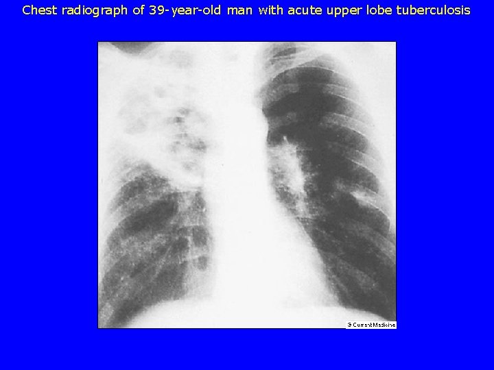 Chest radiograph of 39 -year-old man with acute upper lobe tuberculosis 