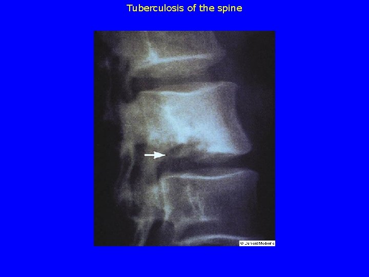 Tuberculosis of the spine 