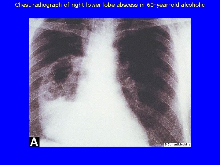 Chest radiograph of right lower lobe abscess in 60 -year-old alcoholic 