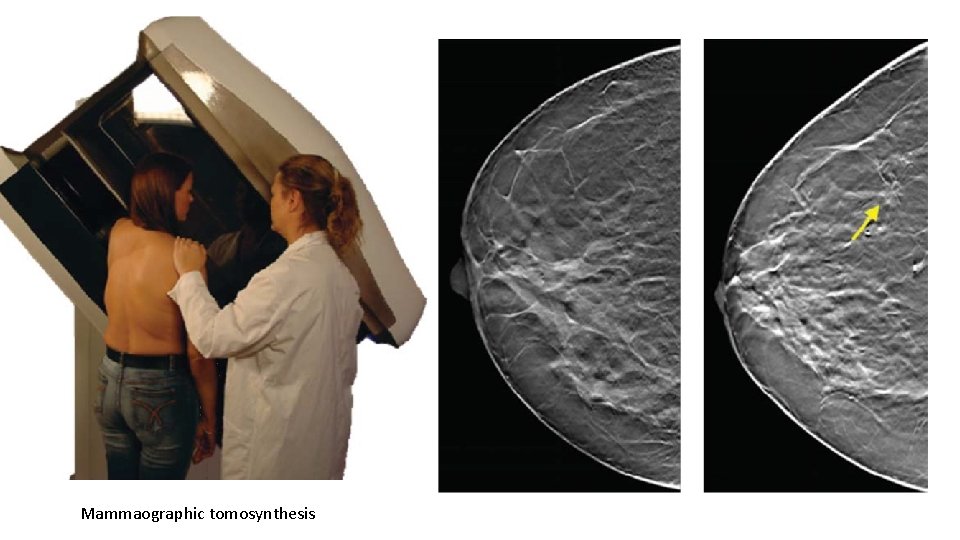 Mammaographic tomosynthesis 