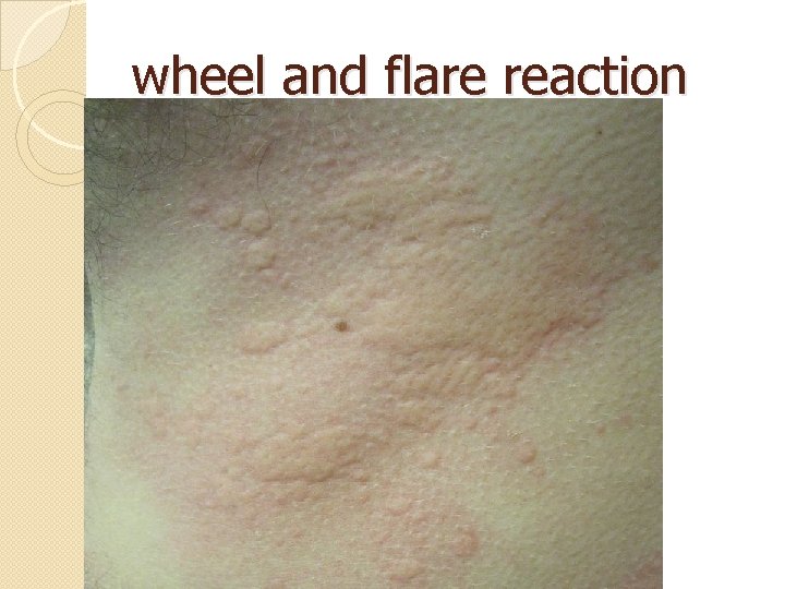 wheel and flare reaction 