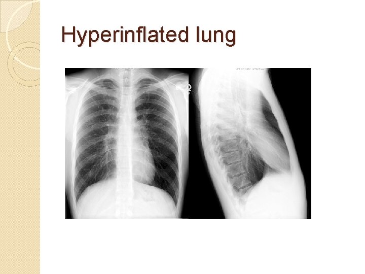 Hyperinflated lung 