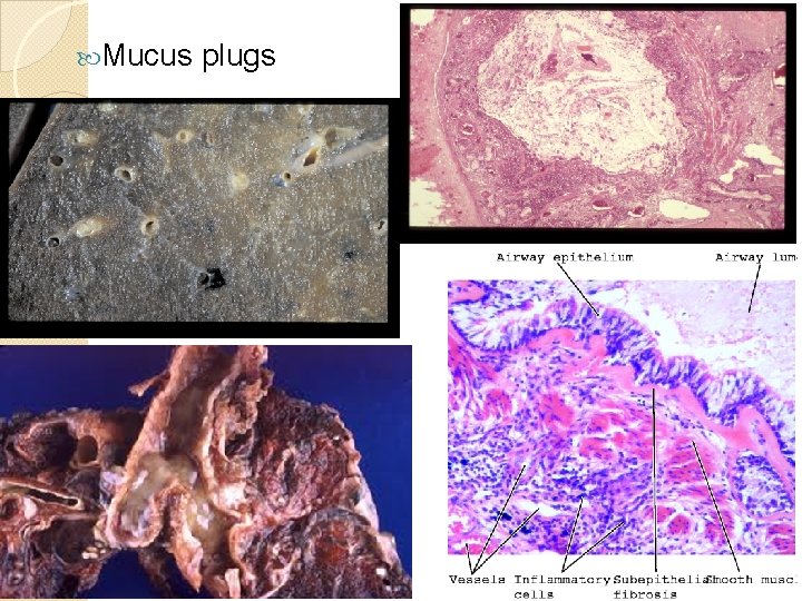  Mucus plugs 