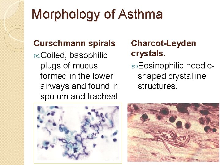 Morphology of Asthma Curschmann spirals Coiled, basophilic plugs of mucus formed in the lower