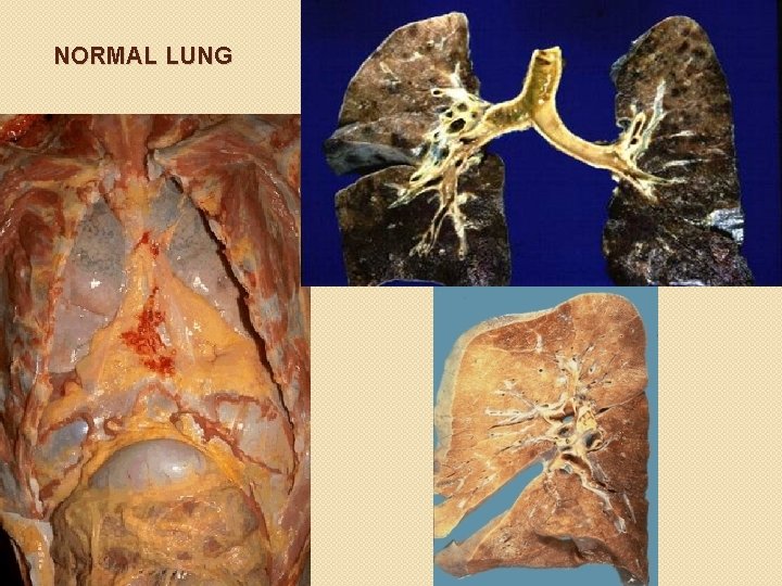 NORMAL LUNG 