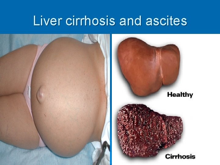 Liver cirrhosis and ascites 