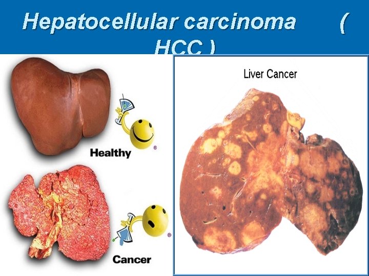 Hepatocellular carcinoma HCC ) ( 