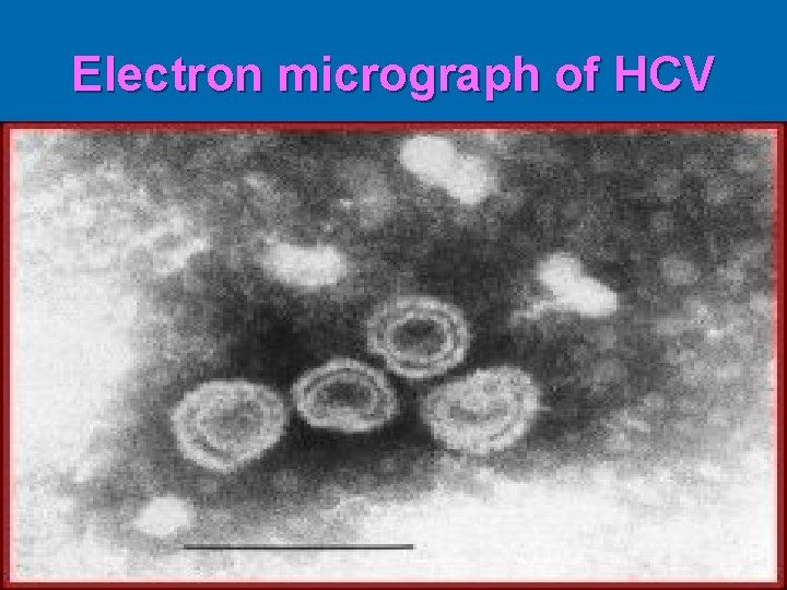 Electron micrograph of HCV 