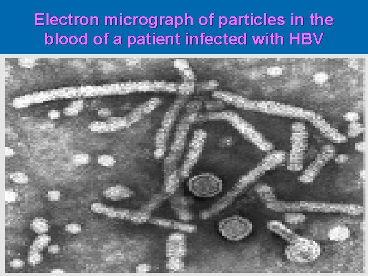 Electron micrograph of particles in the blood of a patient infected with HBV 