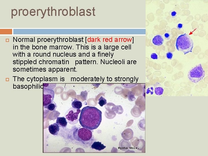 proerythroblast Normal proerythroblast [dark red arrow] in the bone marrow. This is a large