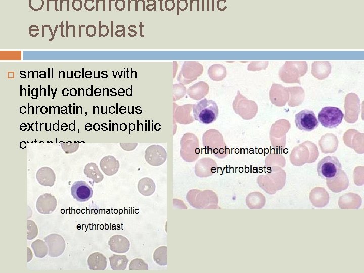 Orthochromatophilic erythroblast small nucleus with highly condensed chromatin, nucleus extruded, eosinophilic cytoplasm 