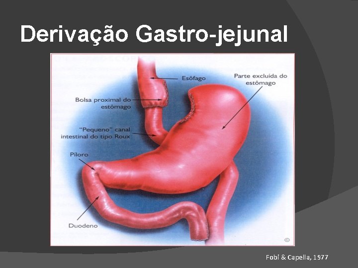 Derivação Gastro-jejunal Fobi & Capella, 1977 