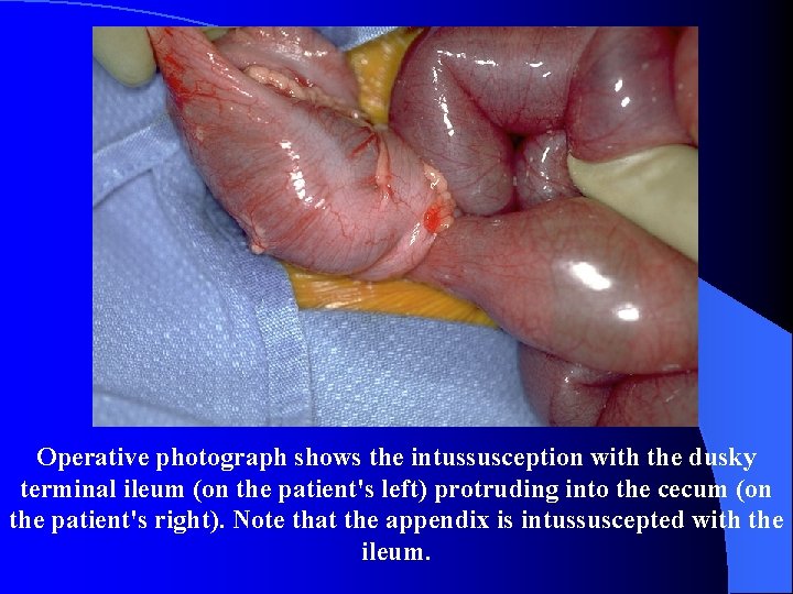 Operative photograph shows the intussusception with the dusky terminal ileum (on the patient's left)