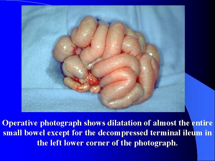 Operative photograph shows dilatation of almost the entire small bowel except for the decompressed
