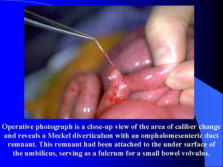 Operative photograph is a close-up view of the area of caliber change and reveals