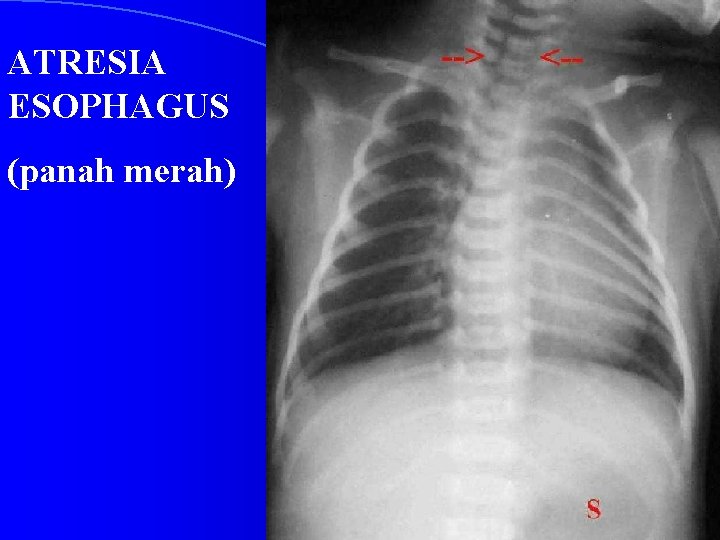 ATRESIA ESOPHAGUS (panah merah) 