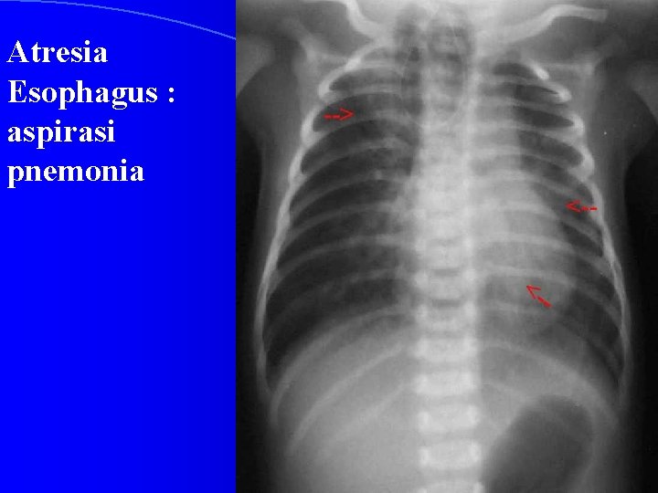 Atresia Esophagus : aspirasi pnemonia 