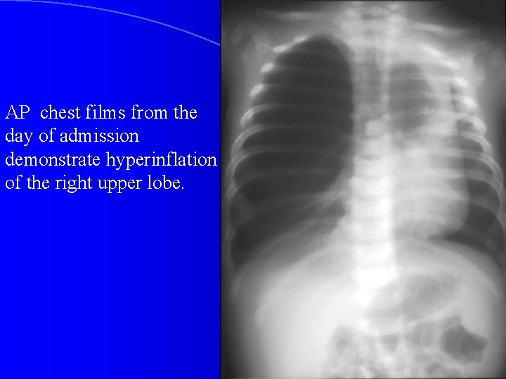 AP chest films from the day of admission demonstrate hyperinflation of the right upper