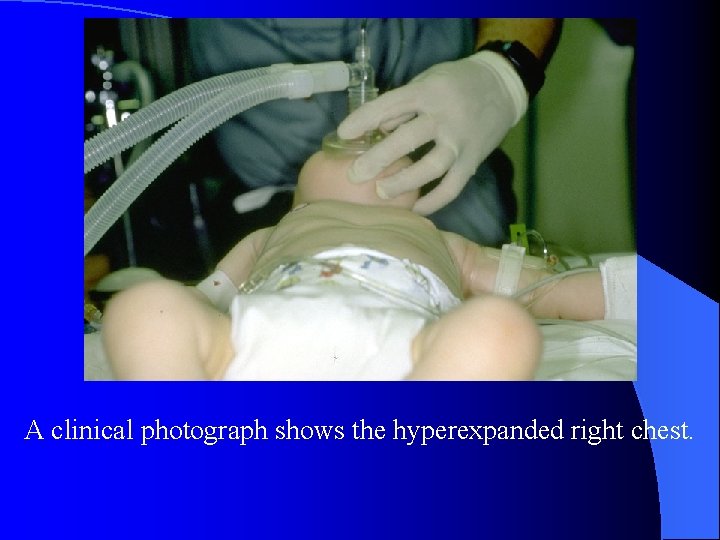 A clinical photograph shows the hyperexpanded right chest. 