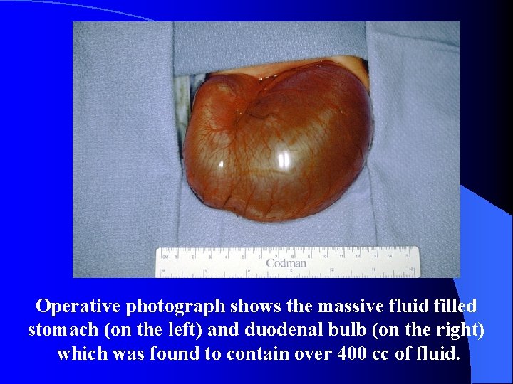 Operative photograph shows the massive fluid filled stomach (on the left) and duodenal bulb