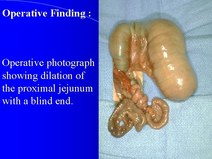 Operative Finding : Operative photograph showing dilation of the proximal jejunum with a blind