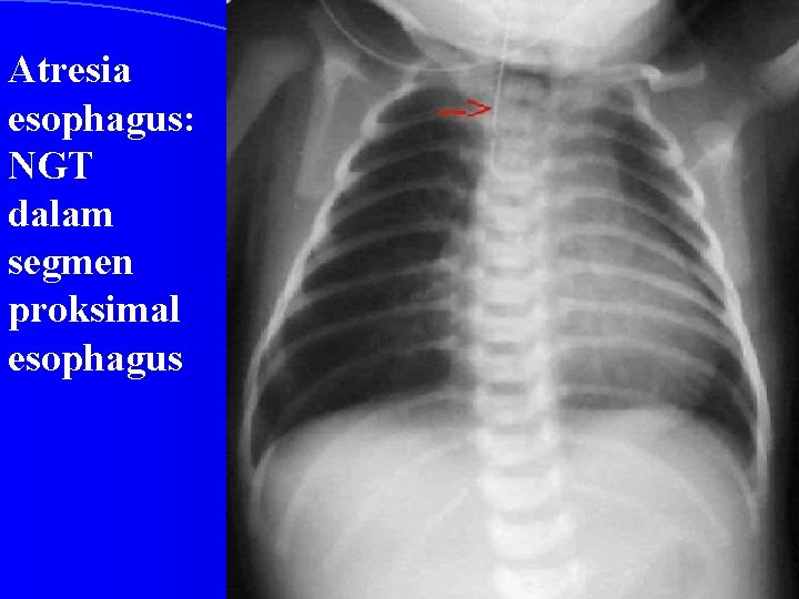 Atresia esophagus: NGT dalam segmen proksimal esophagus 