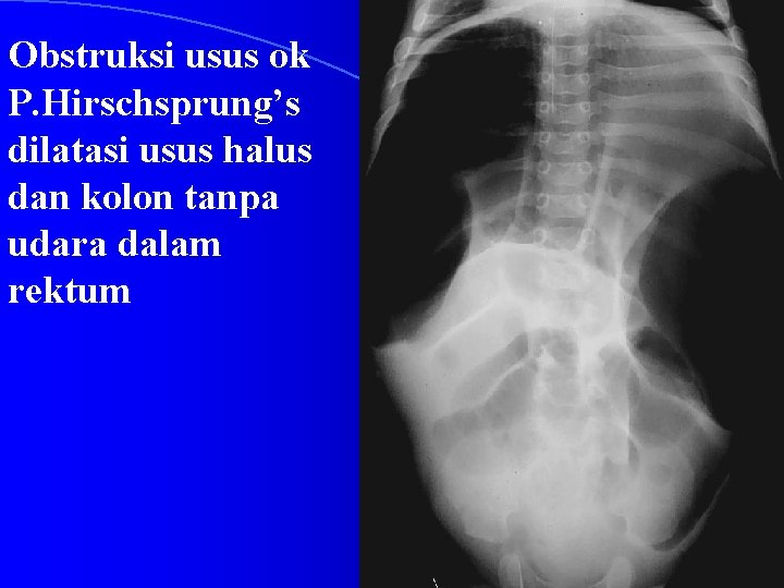 Obstruksi usus ok P. Hirschsprung’s dilatasi usus halus dan kolon tanpa udara dalam rektum